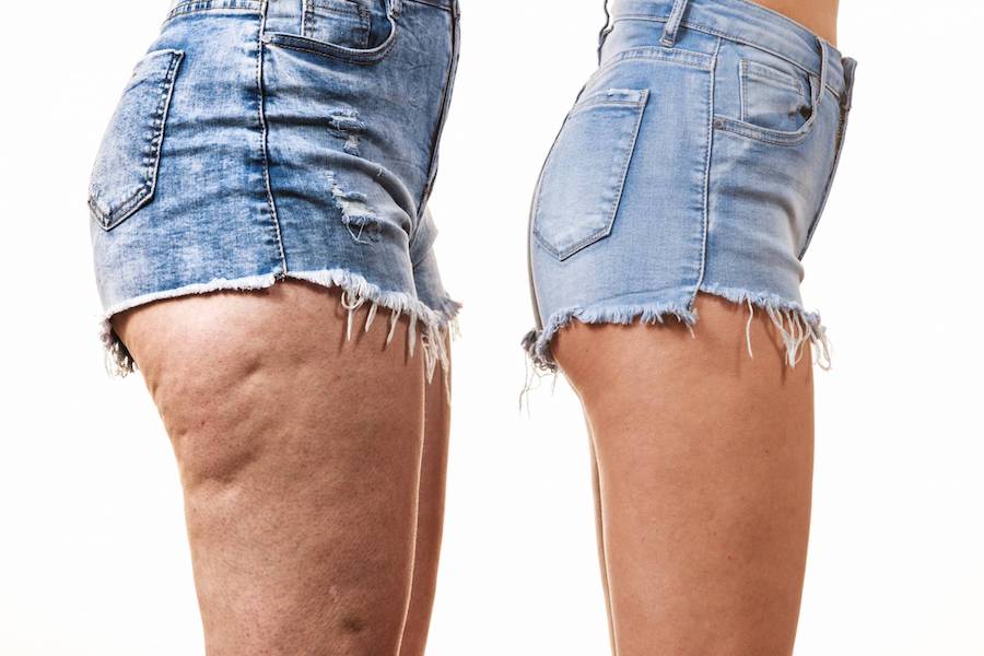 Cellulite, pourquoi les femmes en ont ?