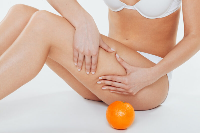 Cellulite, pourquoi les femmes en ont ?